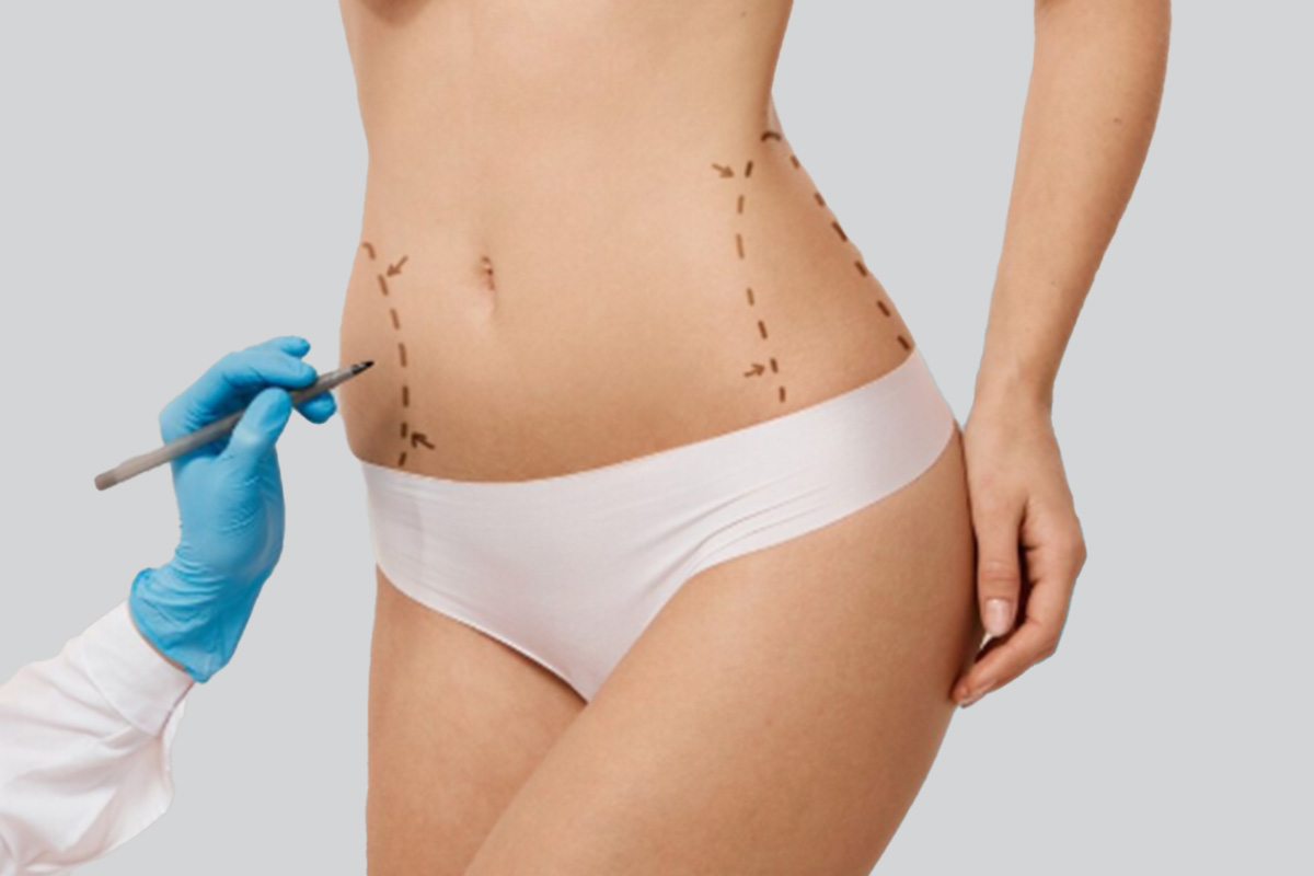 Abdominoplastie en Turquie