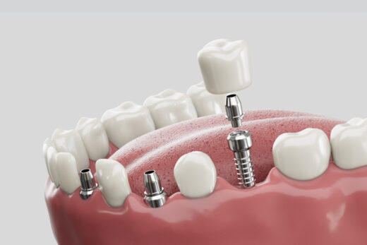 Implant dentaire en Turquie